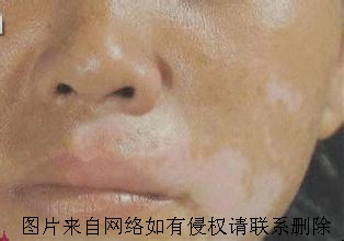 白癜风患者吃无花果好么