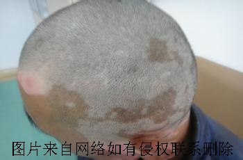 泛发型白癜风要怎么进行治疗