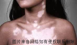 女性白癜风如何治疗见效