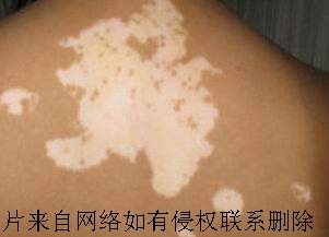 夏季男性白癜风要注意什么