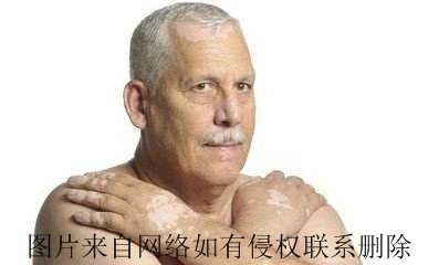 老年人出现白癜风有什么原因