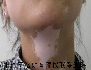 女性朋友治疗白癜风时注意什么